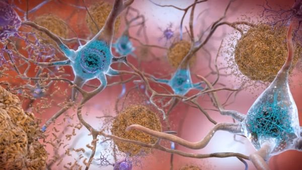 Alzheimer: em feito importante, medicamento consegue retardar progressão da doença
