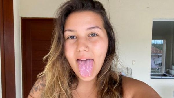 Língua geográfica: a jovem que viralizou ao expor condição que afeta milhões de brasileiros