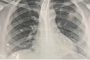 Mulher engole garfo durante refei&ccedil;&atilde;o em Guanambi