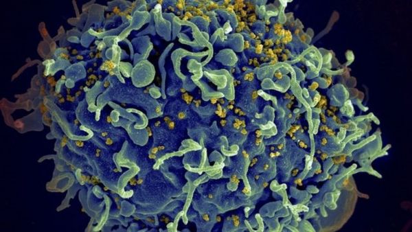 Primeira mulher declarada curada do HIV após transplante de células-tronco