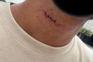 Brumado: Linha com cerol quase decepa pesco&ccedil;o de estudante de Direito no dia da formatura.