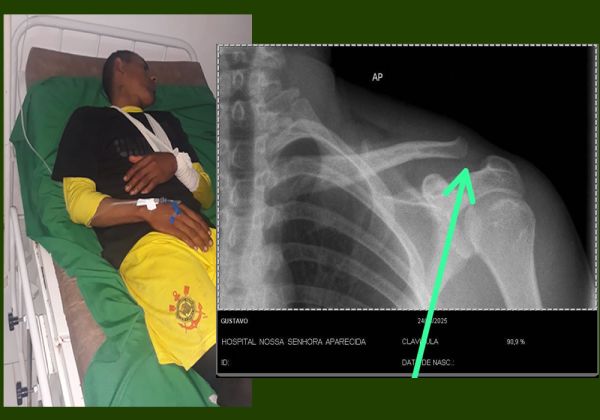 Ibiassucê: Ajudante de Mecânico Sofre Fratura Durante Jogo de Futebol em Caculé.